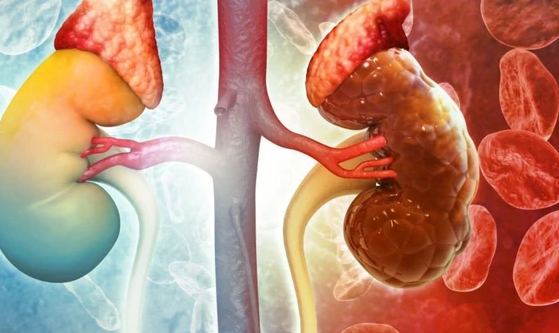 Thanh niên 30 tuổi đang khỏe mạnh sững sờ phát hiện suy thận: Tôi không hề đau, không mệt, sinh hoạt bình thường 1 Ảnh minh họa.