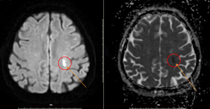 Chụp MRI xác định chính xác tình trạng nhồi máu não. Ảnh: Phòng khám Đa khoa Tâm Anh Quận 7