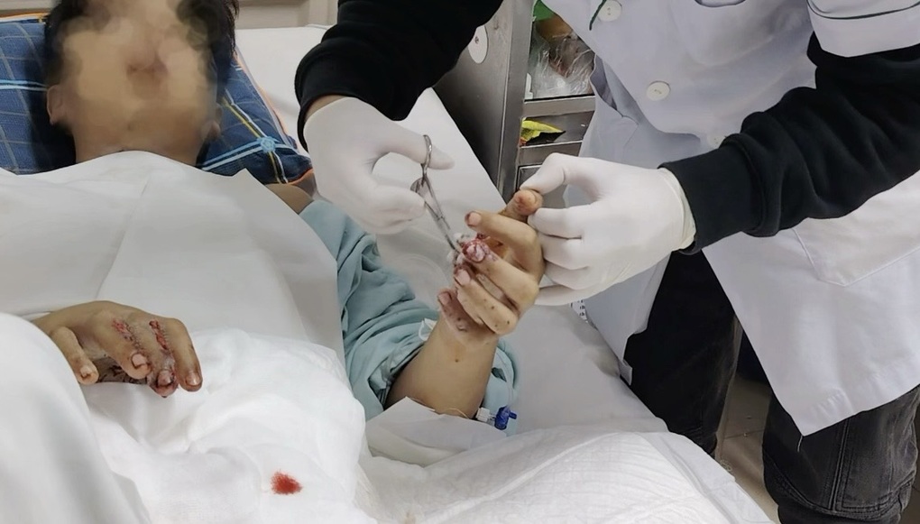 Trong một tuần, 6 ca cấp cứu nghiêm trọng vì pháo nổ - 1