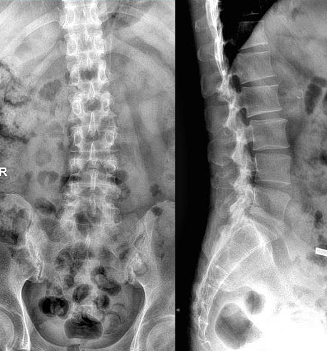 Phim chụp X-quang của anh Quang cho thấy biểu hiện viêm khớp cột sống. Ảnh: Bệnh viện Đa khoa Tâm Anh