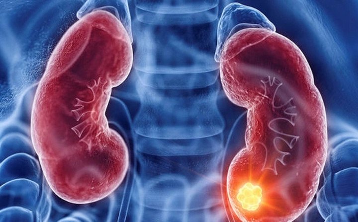 Ung thư thận dễ bị bỏ sót, chỉ phát hiện khi trong nước tiểu có máu 1 Ung thư thận thường tiến triển âm thầm.