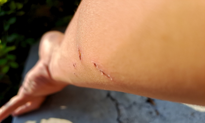 Vết thương do bị chó, mèo cắn, từ đây, virus dại có thể xâm nhập. Ảnh minh họa: Vecteezy