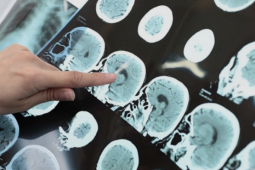 Những 'cú sốc nhiệt' kích hoạt đột quỵ khi trời lạnh