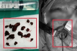 Nấm đen ăn mòn xương xoang hàm người đàn ông khỏe mạnh