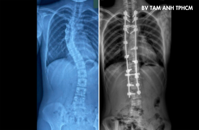 Phim chụp X-quang tình trạng cột sống bệnh nhi trước (trái) và sau phẫu thuật. Ảnh: Bệnh viện Đa khoa Tâm Anh