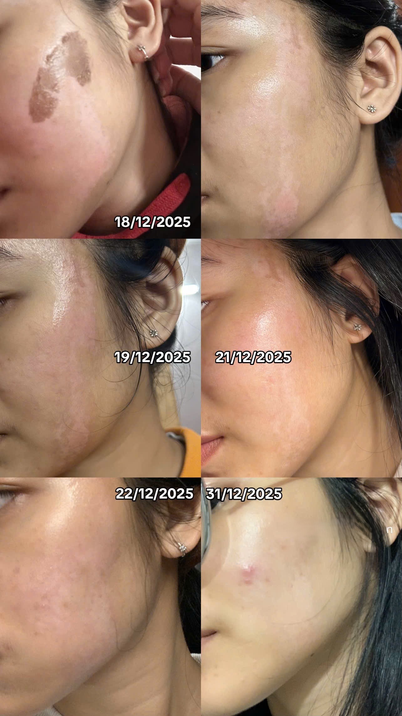 Cô gái “banh mặt” khi peel da ở spa: Suýt mất Tết, tốn 10 lần tiền chữa nỗi đau- Ảnh 7.