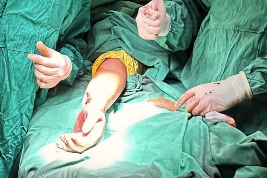 Nam thanh niên bị máy cuốn làm đứt lìa tay trong ca trực đêm cận Tết - 2