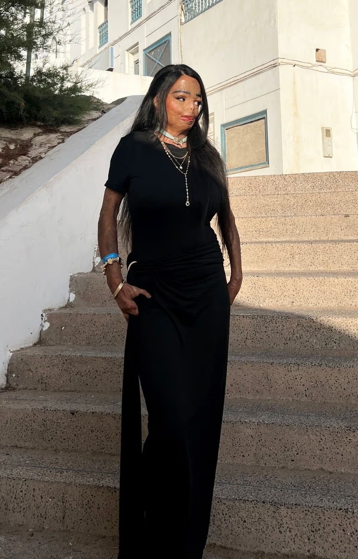 Dầu gội đầu bắt lửa, cô gái bị bỏng nửa người và mất 7 ngón tay- Ảnh 2.