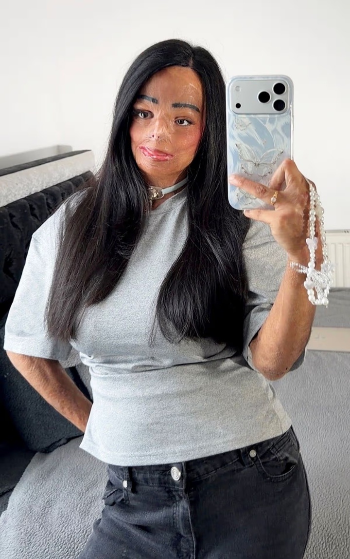 Dầu gội đầu bắt lửa, cô gái bị bỏng nửa người và mất 7 ngón tay- Ảnh 3.