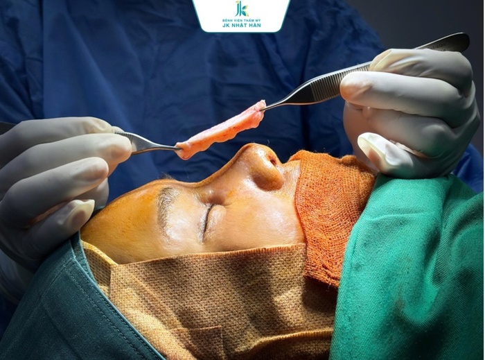 Nhiều phụ nữ chọn nâng mũi tự thân vì không muốn dùng vật liệu nhân tạo