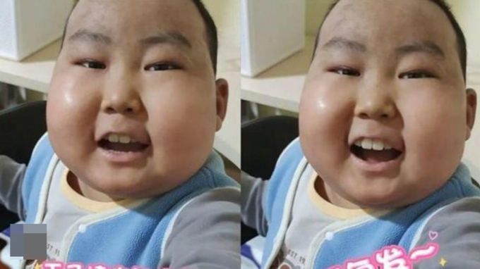 Tác dụng phụ của thuốc khiến gương mặt của Hạo Hạo sưng phù. Ảnh: HK01