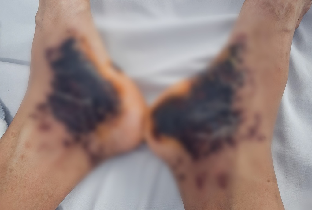 Bàn chân bầm đen, báo hiệu căn bệnh nguy hiểm từ những vết ban nhỏ - 2