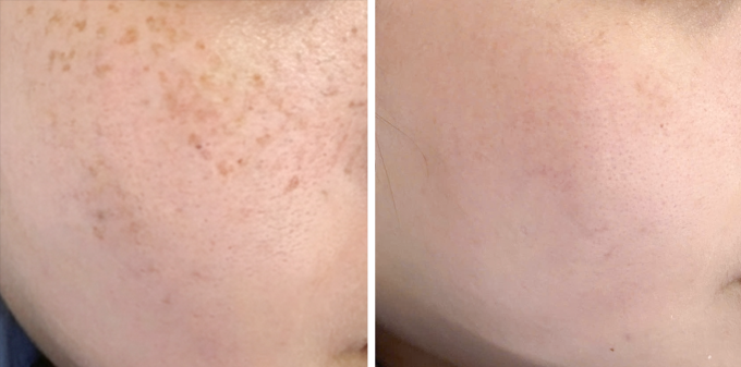 Các mảng nám và tàn nhang của chị Hường giảm hẳn sau điều trị. Ảnh: Bệnh viện Đa khoa Tâm Anh