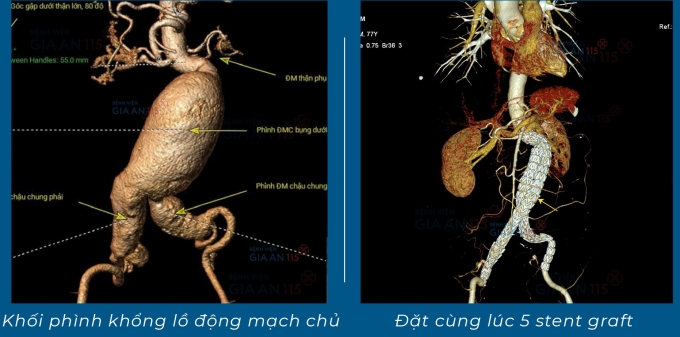 Hình ảnh mạch máu có túi phình (bên trái) và sau khi đăt stent (bên phải). Ảnh: Bệnh viện cung cấp