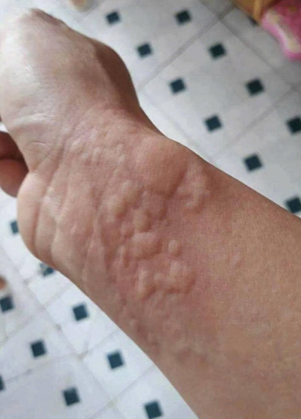 'Món lạ' trong mâm cỗ tất niên khiến người đàn ông suýt 'mất Tết' 2 dị ứng - Ảnh 2.