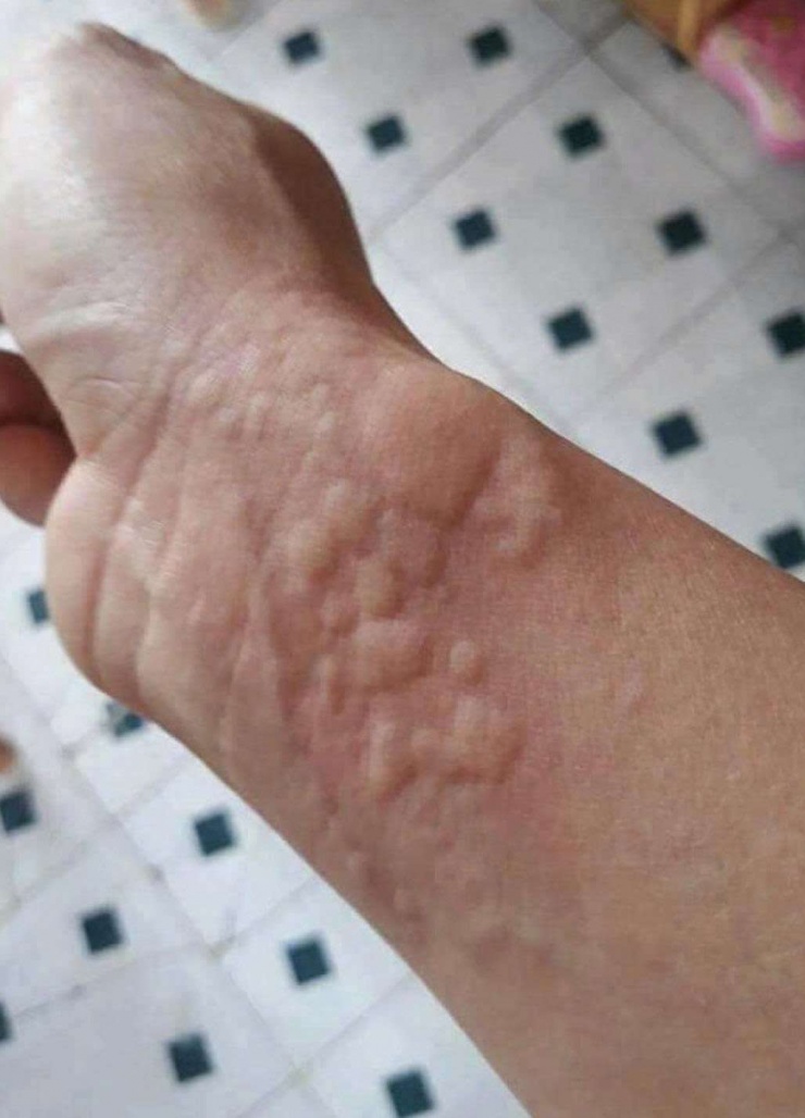 Bệnh nhân nổi mần mề đay khắp cơ thể. Ảnh: BSCC