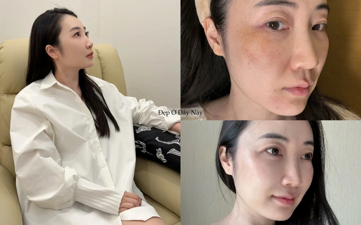 1 năm kiên trì dùng loại 4 serum dưỡng sáng này, nám má 2 bên của tôi đỡ hẳn- Ảnh 2.