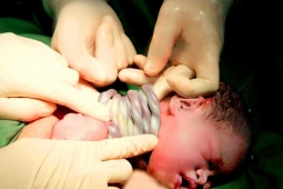 Hy hữu: Bé gái chào đời với 9 vòng dây rốn quấn cổ