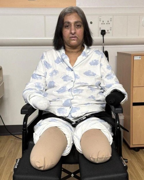 Bà Manjit Sangha mất tứ chi do nhiễm trùng huyết nghi do chó liếm vết thương. Ảnh: Kam Sangha