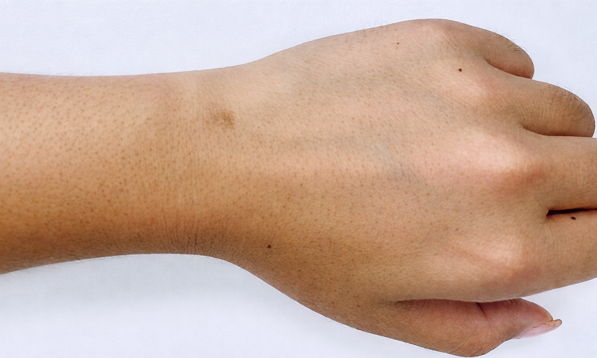 5 loai ung thu di truyen thuong gap