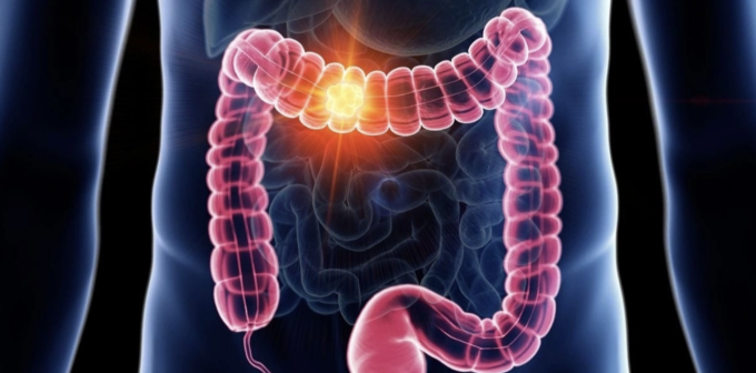 Mô phỏng khối u ung thư phát triển trong ruột bệnh nhân. Ảnh: Diabetes