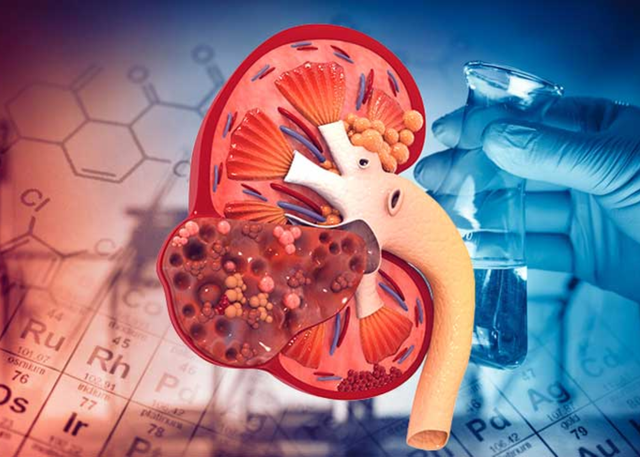 8 thói quen gây suy thận, người Việt cần biết để tránh 1 Ảnh minh họa.