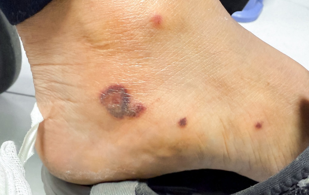 Bàn chân bầm đen, báo hiệu căn bệnh nguy hiểm từ những vết ban nhỏ - 1