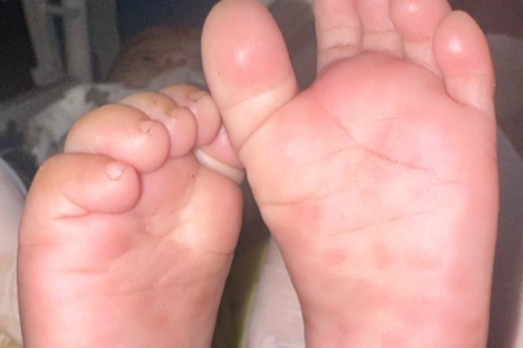 Bé trai 3 tuổi mắc giang mai bẩm sinh - 1