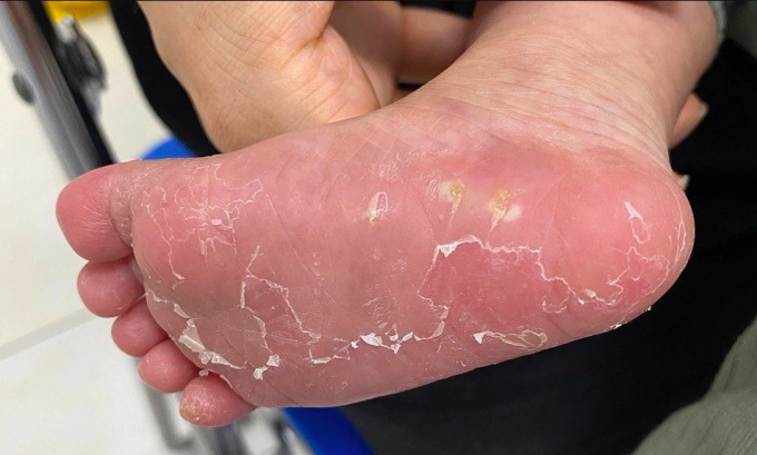 Một em bé bị bong da tay, da chân ngay sau sinh - dấu hiệu của bệnh giang mai bẩm sinh. Ảnh:Thu Ngô