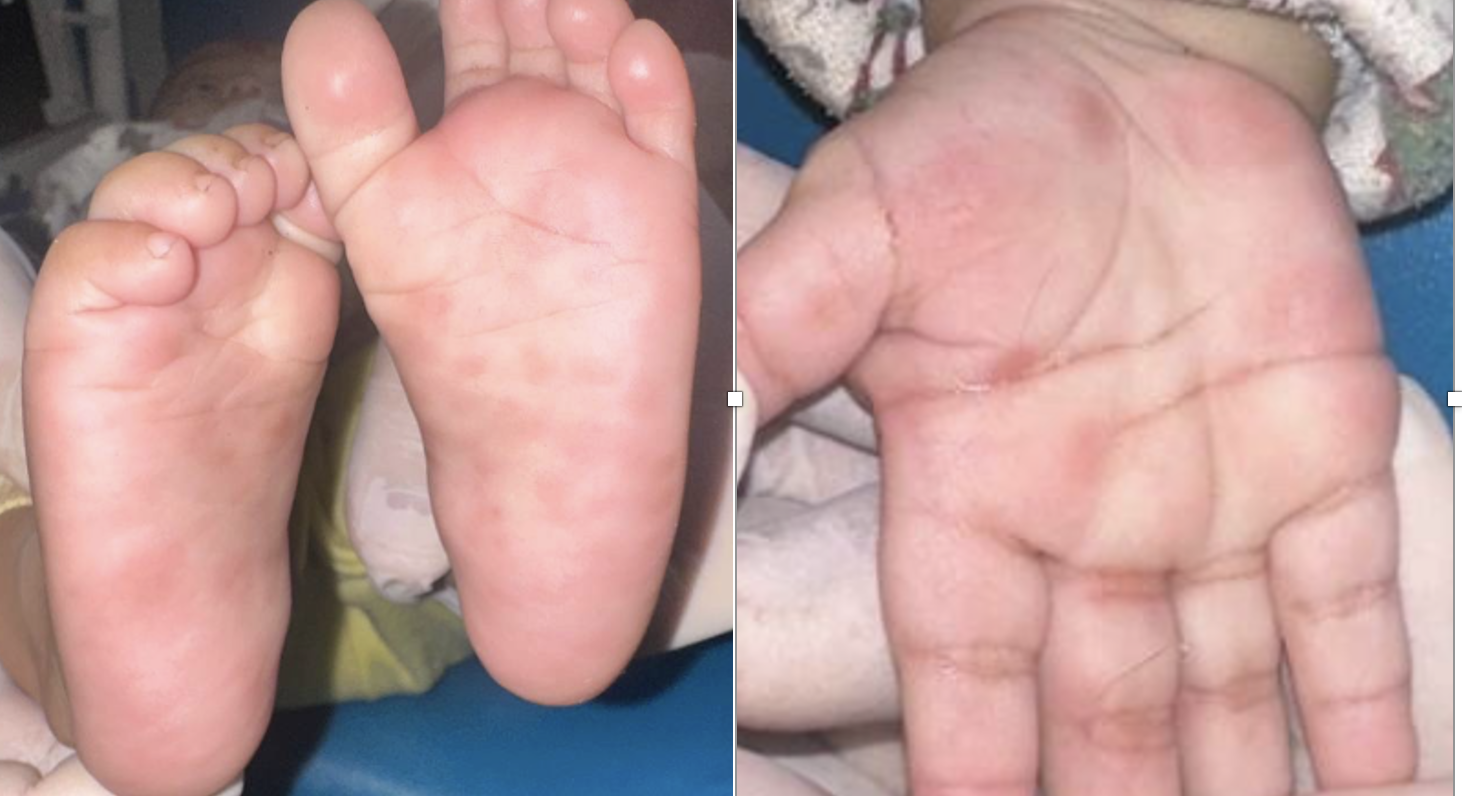 giang mai - Ảnh 1.