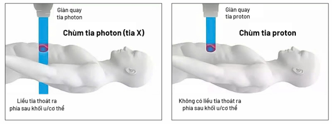 Xạ trị photon (tia X) đưa liều xạ vào khối u nhưng vẫn có thể đi xuyên qua phía sau, có thể gây tổn thương mô lành quanh đường đi của tia; trong khi đó xạ trị proton hiện đại với tia năng lượng biết dừng đúng chỗ ngay vị trí khối u để tiêu diệt khối u.Ảnh: Bệnh viện Tâm Anh