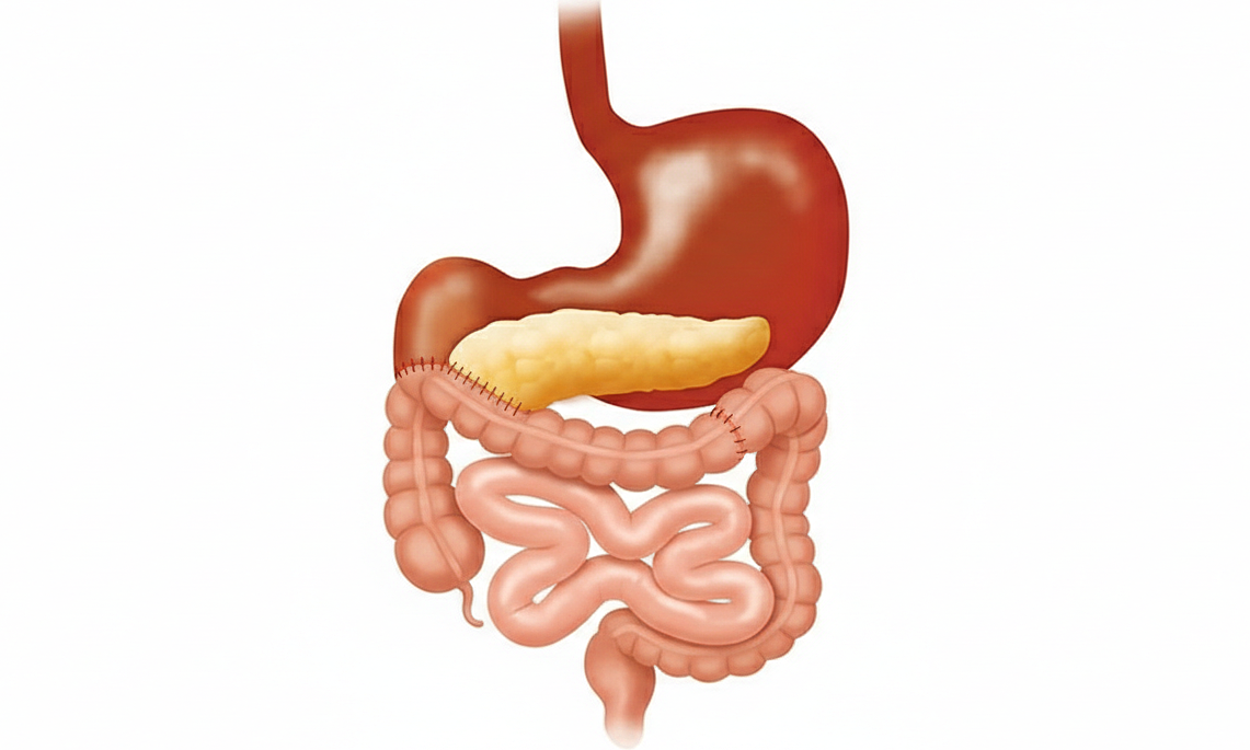 Bệnh whipple: Cách phòng ngừa & chữa bệnh 1 Benh whipple Cach phong ngua chua benh