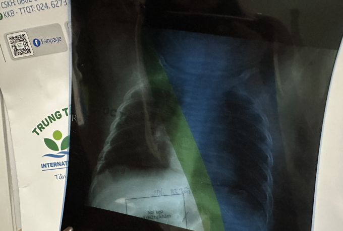 Xquang phổi của bé con chị Linh xác định viêm phổi nhẹ, kèm viêm tai giữa, ứ dịch, ho nhiều, buộc phải nhập viện. Ảnh: Nhân vật cung cấp