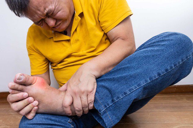 Cơn gout cấp gây sưng, viêm và đau dữ dội.