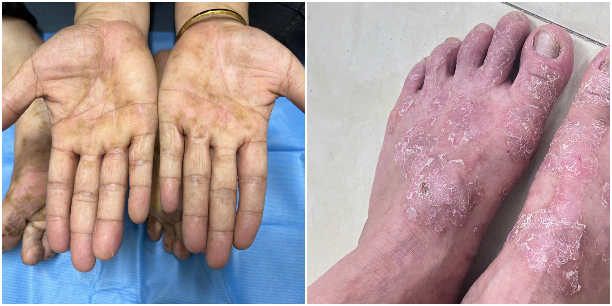 Chuyên gia chỉ cách kiểm soát viêm da cơ địa mùa đông - Ảnh 1. viêm da cơ địa - Ảnh 1.