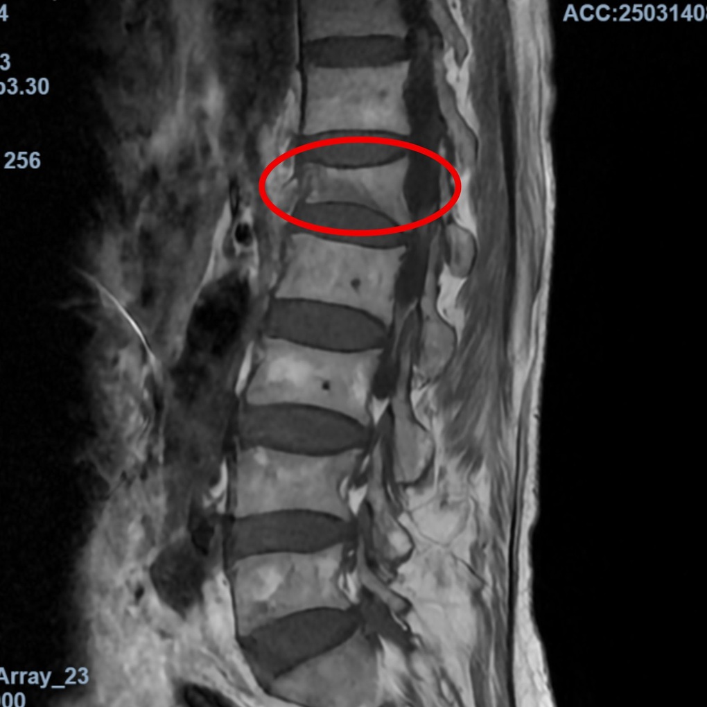 Cụ bà 73 tuổi đau lưng dữ dội, nằm liệt giường sau cái kéo tay của cháu - 1