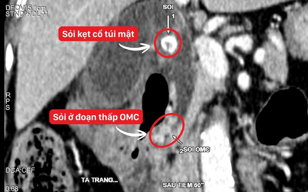 Cụ bà 95 tuổi nguy kịch vì viêm túi mật hoại tử - 1