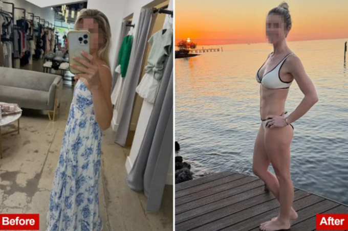 Katrina Daphne trước (trái) và sau khi nâng ngực. Ảnh: Katrina Daphne