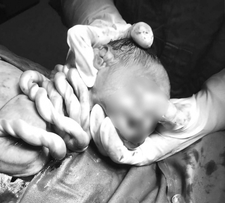 Thai nhi bị dây rốn quấn cổ đến 5 vòng rất hiếm gặp trong sản khoa. Ảnh BVCC