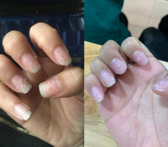 Tự phá móng gel, gỡ/bóc móng giả tại nhà có thể khiến bề mặt móng thật tổn thương nặng nề.