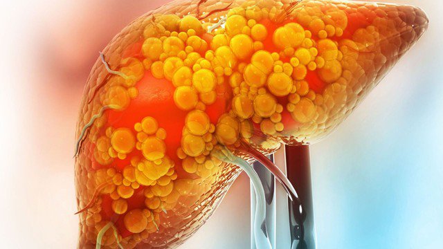 Một thói quen ăn uống quen thuộc có thể làm tăng nguy cơ ung thư gan, người Việt nên tránh 3 Ảnh minh họa.