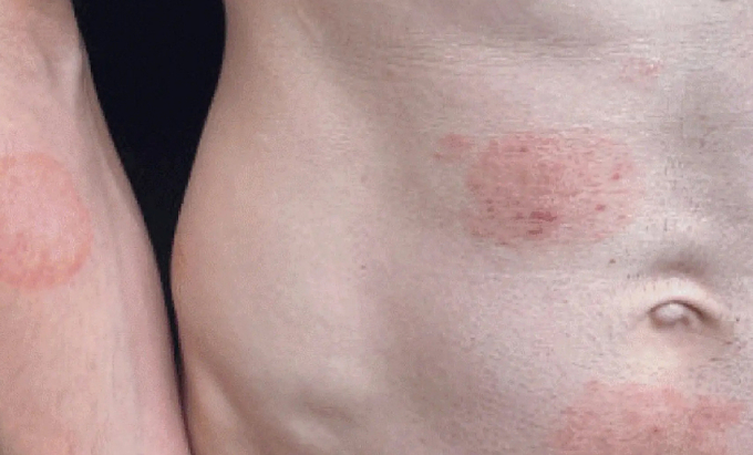 Các triệu chứng của chủng TMVII tương tự như bệnh nấm da thông thường, với biểu hiện điển hình là những mảng da bong tróc vảy, hình tròn và gây ngứa dữ dội. Ảnh: CDC