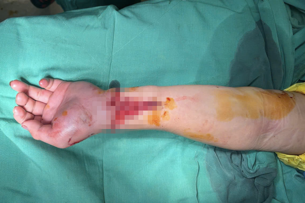 Nam thanh niên bị máy cuốn làm đứt lìa tay trong ca trực đêm cận Tết - 1