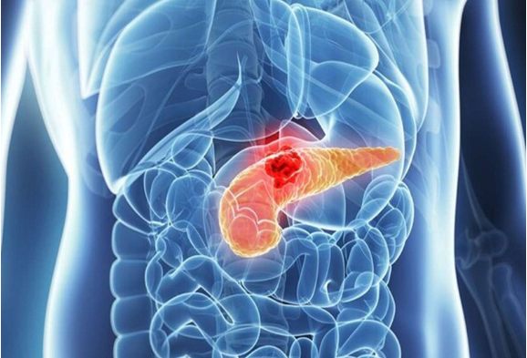 Người đàn ông 45 tuổi phát hiện ung thư tuyến tụy từ dấu hiệu nhiều người Việt bỏ qua - 1