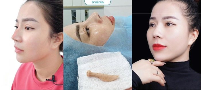 Nhiều phụ nữ chọn nâng mũi tự thân vì không muốn dùng vật liệu nhân tạo
