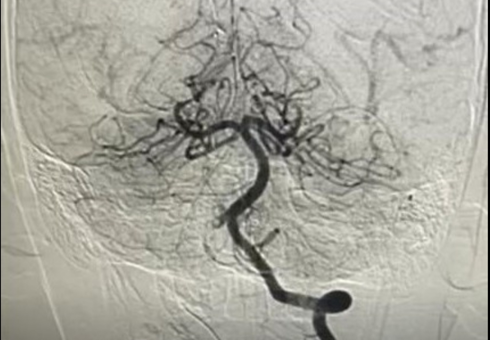 Nhồi máu não - Ảnh 1.