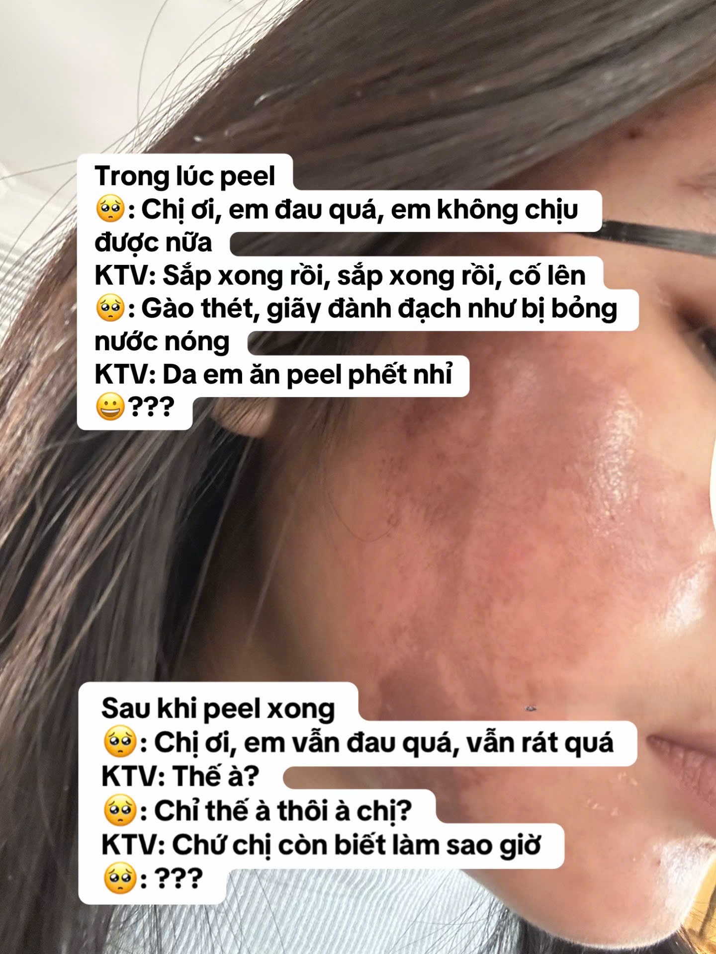 Cô gái “banh mặt” khi peel da ở spa: Suýt mất Tết, tốn 10 lần tiền chữa nỗi đau- Ảnh 2. Cô gái “banh mặt” khi peel da ở spa: Suýt mất Tết, tốn 10 lần tiền chữa nỗi đau- Ảnh 2.