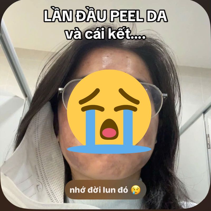 Cô gái “banh mặt” khi peel da ở spa: Suýt mất Tết, tốn 10 lần tiền chữa nỗi đau- Ảnh 1.