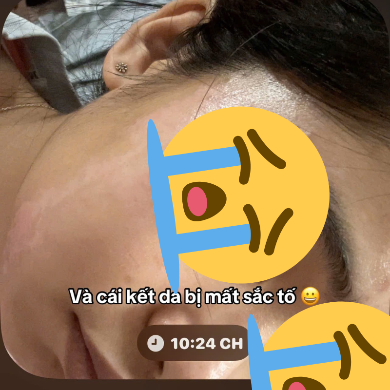 Cô gái “banh mặt” khi peel da ở spa: Suýt mất Tết, tốn 10 lần tiền chữa nỗi đau- Ảnh 8.