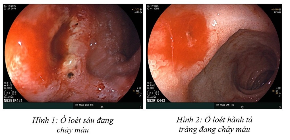 Tháng cuối năm, nhiều người trẻ đi cấp cứu vì xuất huyết dạ dày - 1